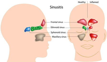 1760561905_sinuses Sinus Disease in Poway, CA