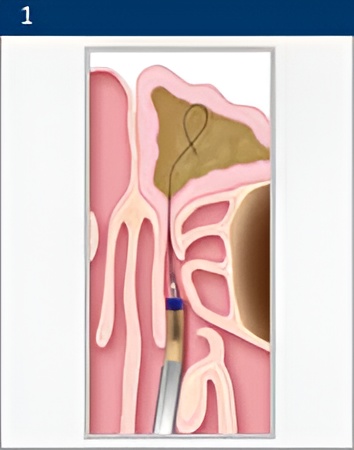 balloon-sinuplasty 1 Sinus Disease in Poway, CA