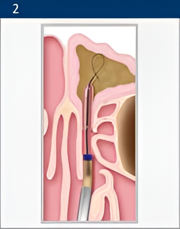 balloon-sinuplasty 2 Sinus Disease in Poway, CA