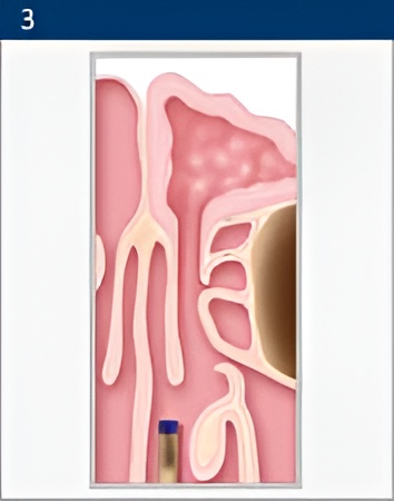 balloon-sinuplasty 3 Sinus Disease in Poway, CA